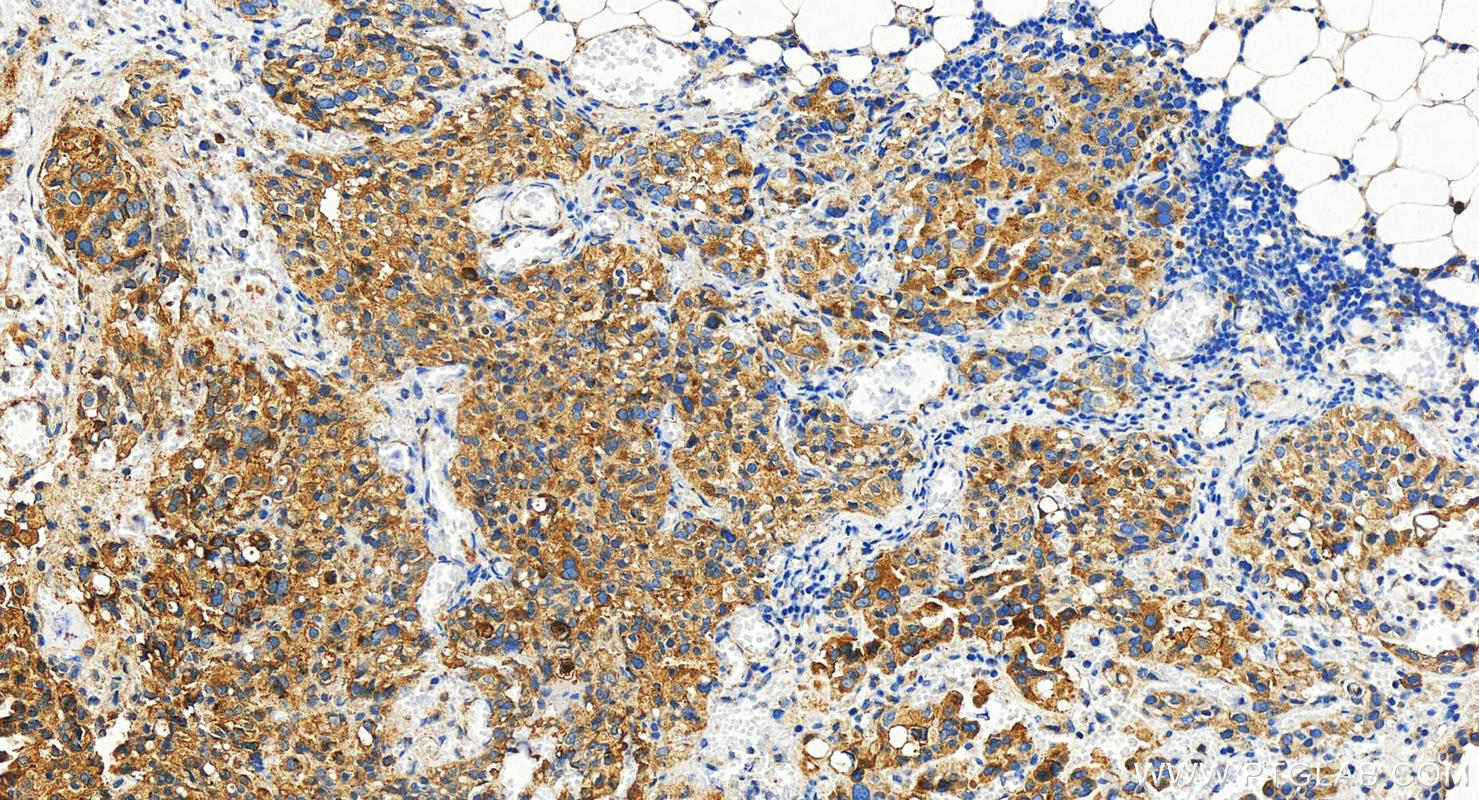 Immunohistochemistry (IHC) staining of human ovary cancer tissue using Integrin beta-8 Polyclonal antibody (29775-1-AP)