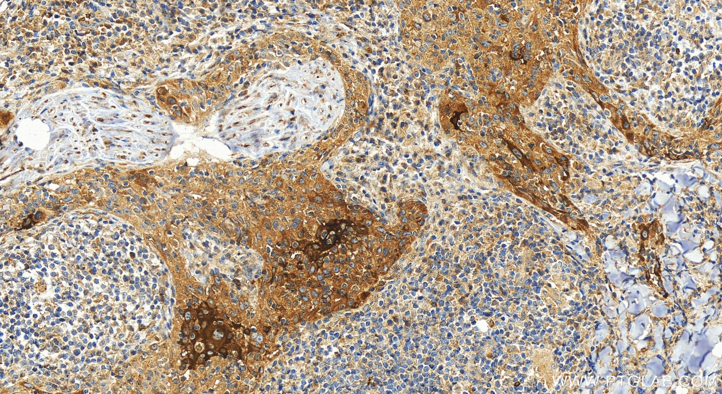 Immunohistochemistry (IHC) staining of human skin cancer tissue using Involucrin Polyclonal antibody (28462-1-AP)