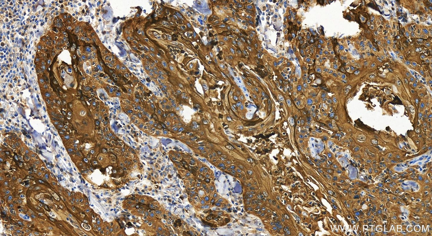 Immunohistochemistry (IHC) staining of human skin cancer tissue using Involucrin Polyclonal antibody (28462-1-AP)