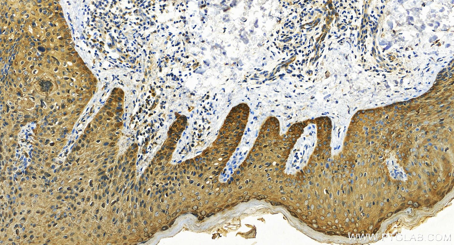 Immunohistochemistry (IHC) staining of human brown disease using Involucrin Polyclonal antibody (28462-1-AP)