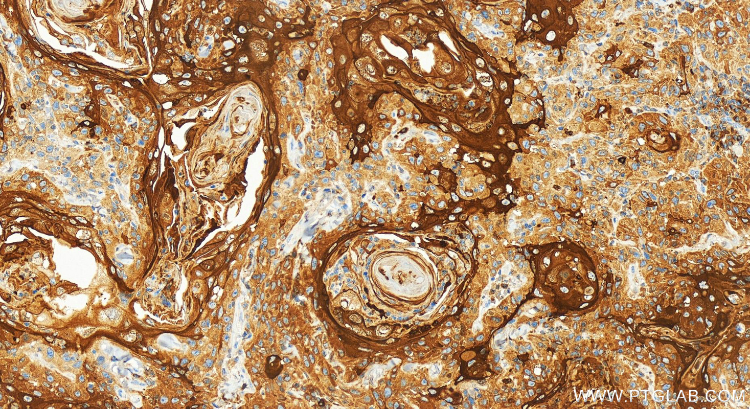 Immunohistochemistry (IHC) staining of human skin cancer tissue using Involucrin Recombinant antibody (83649-5-RR)