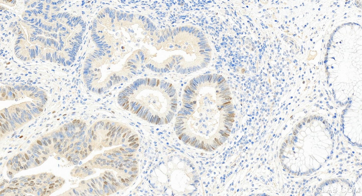 Immunohistochemistry (IHC) staining of human colon cancer tissue using JMY Polyclonal antibody (25098-1-AP)