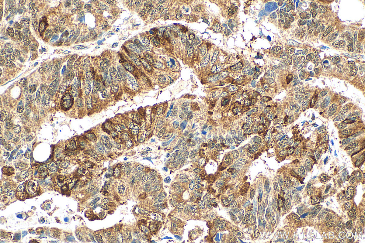 Immunohistochemistry (IHC) staining of human colon cancer tissue using JMY Polyclonal antibody (25098-1-AP)