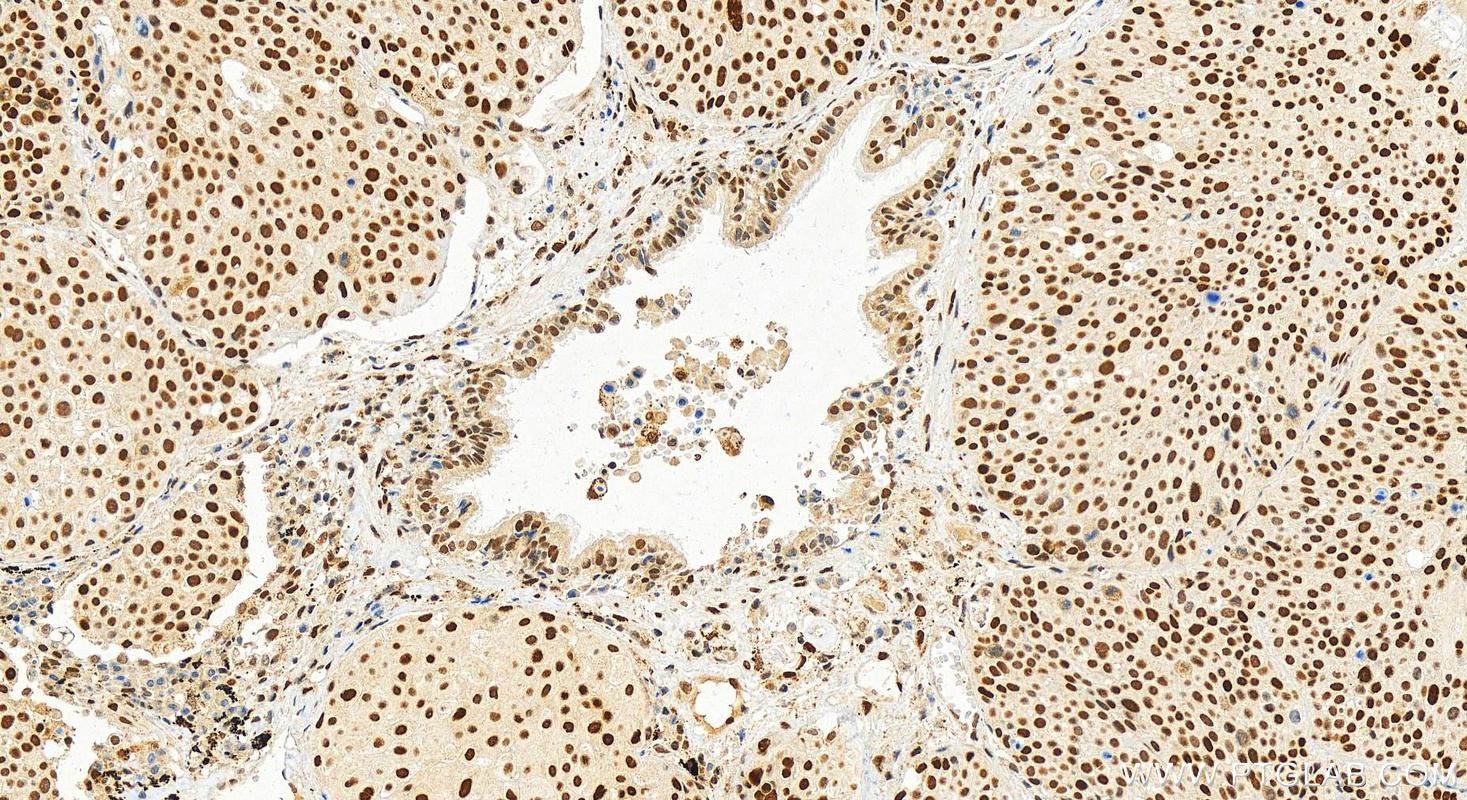 Immunohistochemistry (IHC) staining of human lung squamous cell cancer using JUN Polyclonal antibody (24909-1-AP)