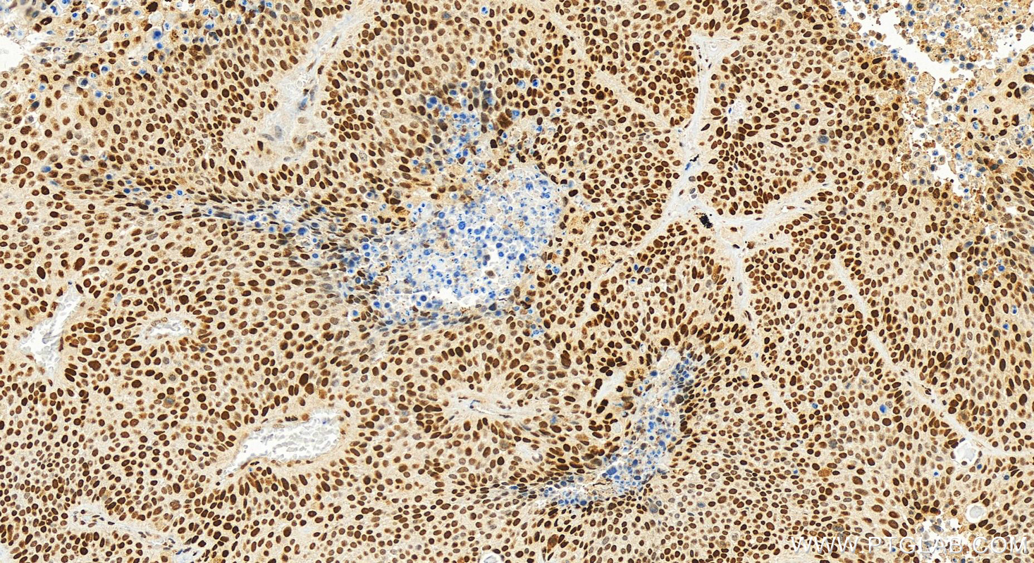 Immunohistochemistry (IHC) staining of human lung squamous cell cancer using JUN Polyclonal antibody (24909-1-AP)