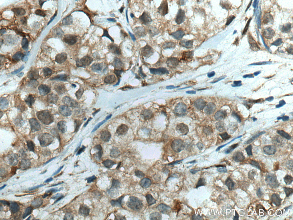 Immunohistochemistry (IHC) staining of human breast cancer tissue using JUNB Polyclonal antibody (10486-1-AP)