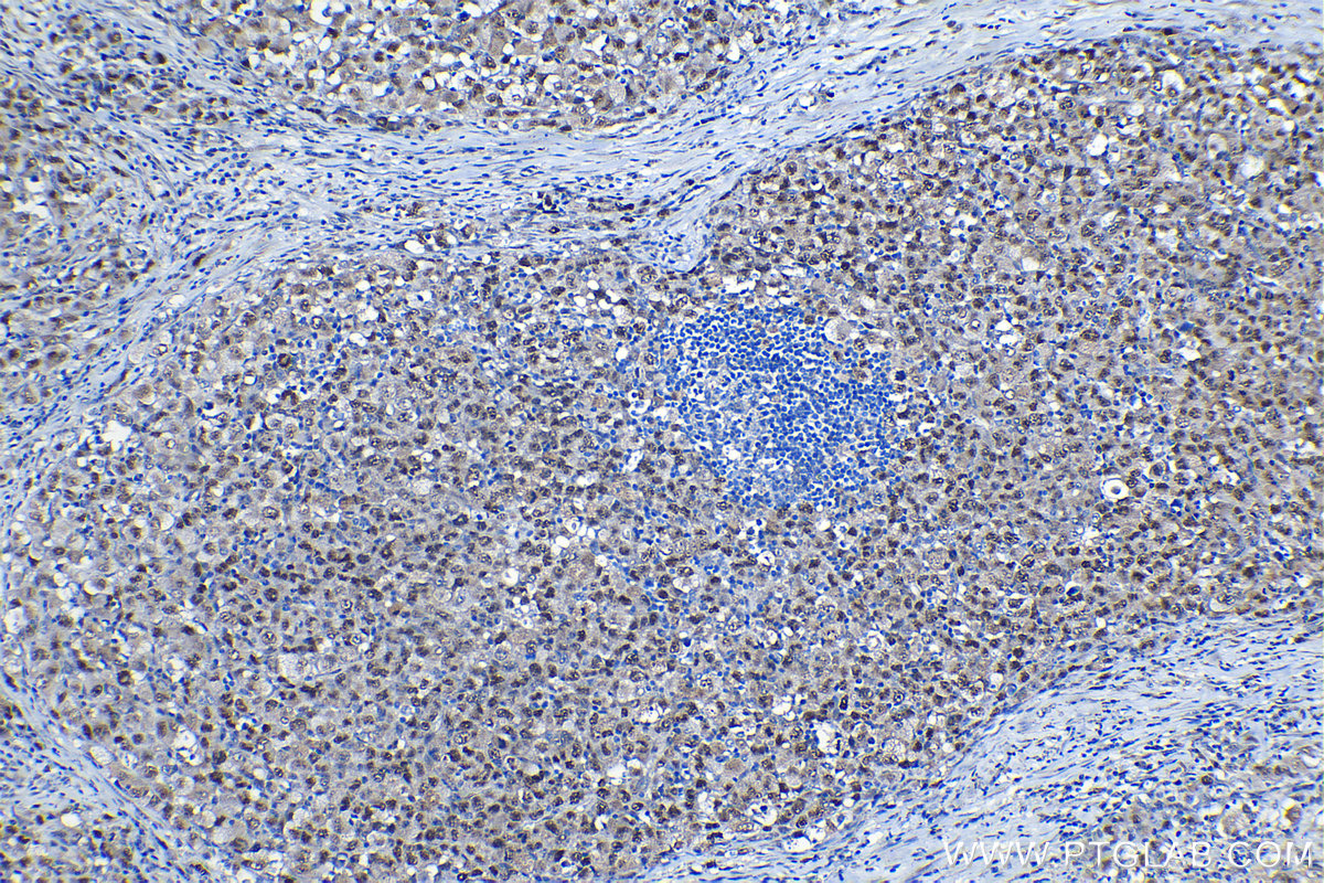 Immunohistochemistry (IHC) staining of human lymphoma tissue using JUNB Polyclonal antibody (10486-1-AP)