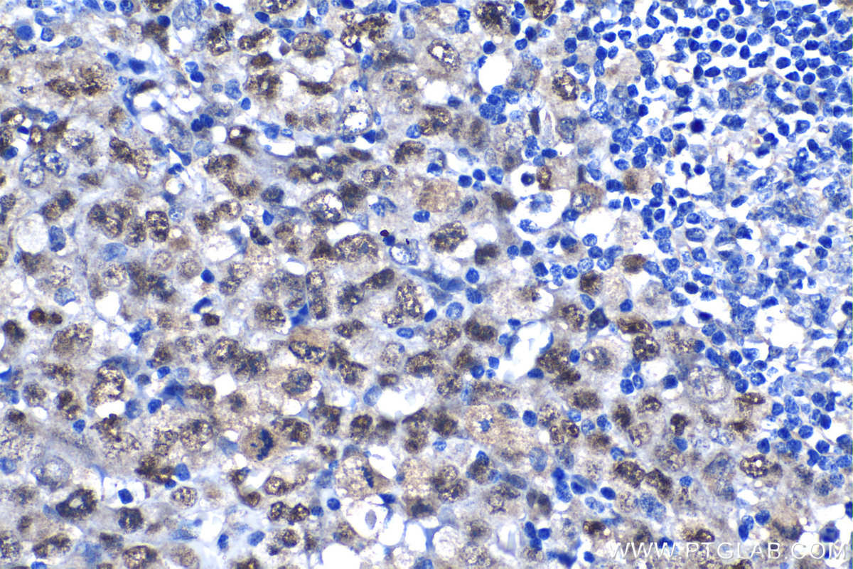 Immunohistochemistry (IHC) staining of human lymphoma tissue using JUNB Polyclonal antibody (10486-1-AP)