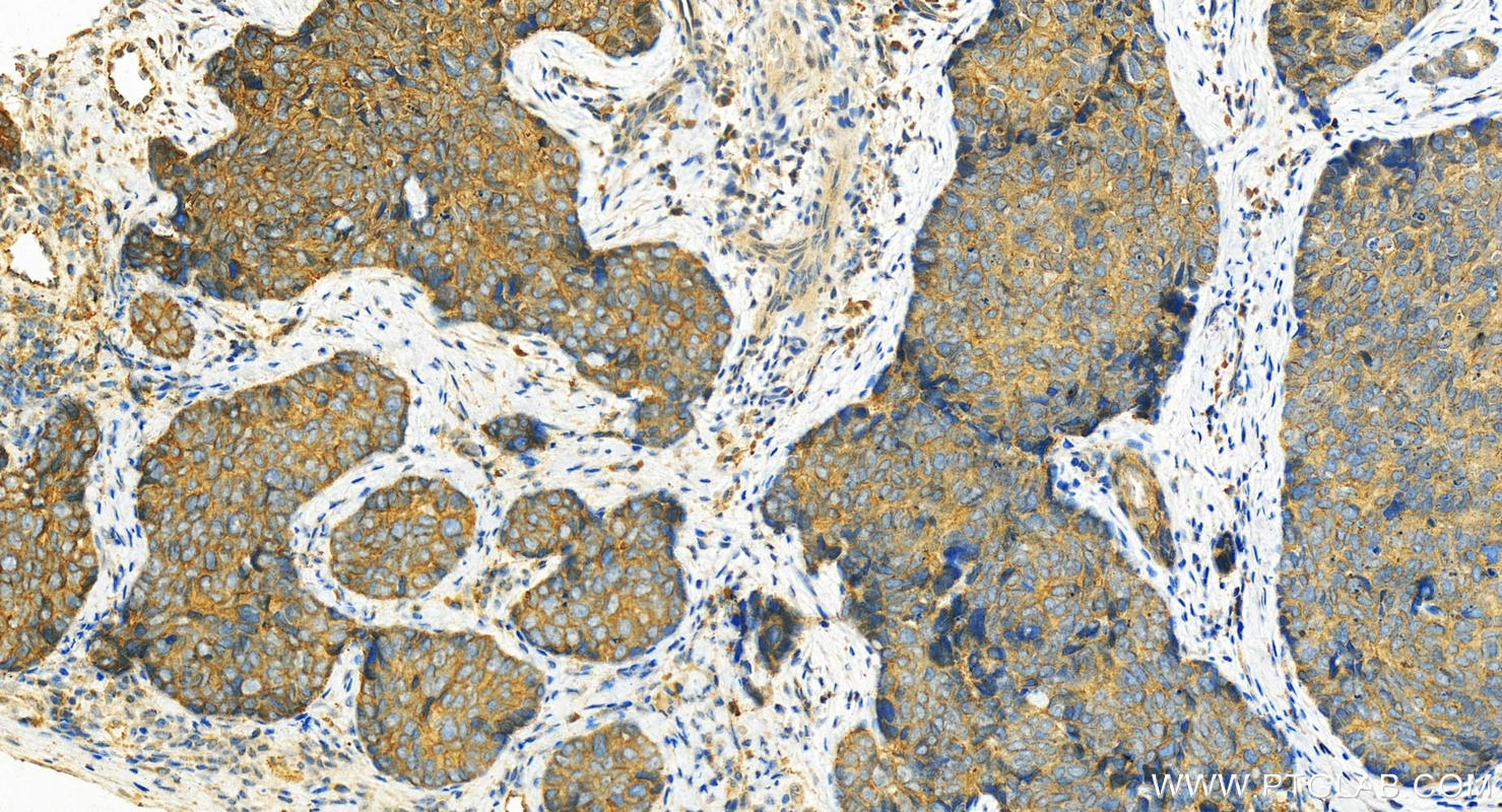 Immunohistochemistry (IHC) staining of human bowen disease using Gamma Catenin Polyclonal antibody (11146-1-AP)