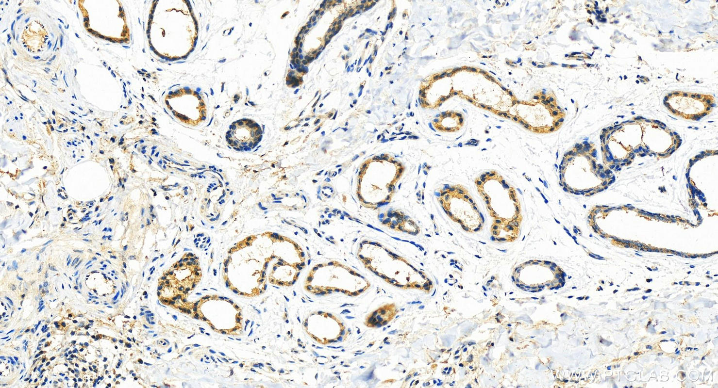 Immunohistochemistry (IHC) staining of human bowen disease using Gamma Catenin Polyclonal antibody (11146-1-AP)