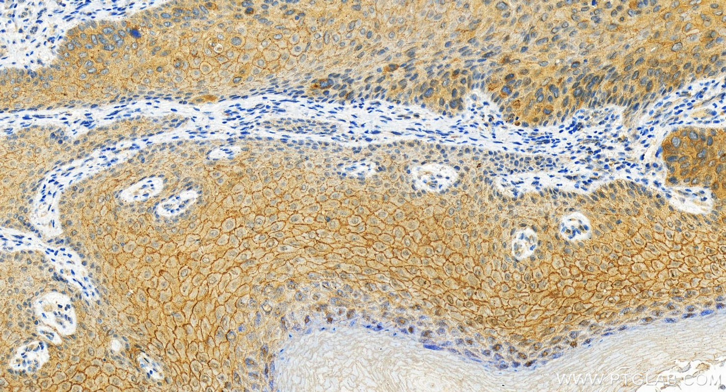 Immunohistochemistry (IHC) staining of human bowen disease using Gamma Catenin Polyclonal antibody (11146-1-AP)