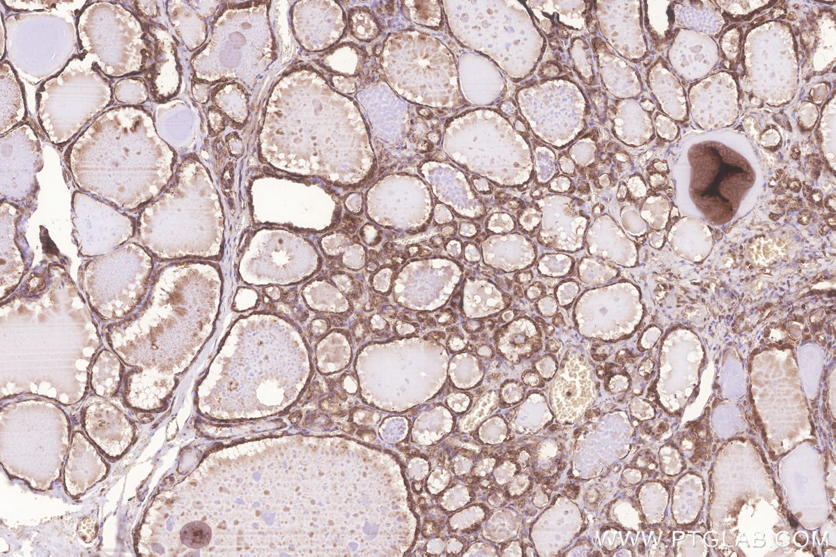 Immunohistochemistry (IHC) staining of human thyroid cancer tissue using KARS Polyclonal antibody (14951-1-AP)