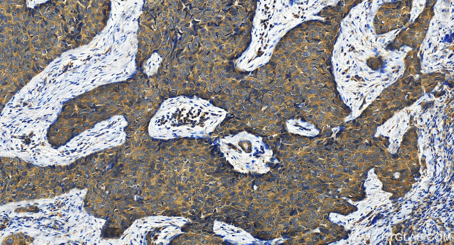 Immunohistochemistry (IHC) staining of human bowen disease using KATNA1 Polyclonal antibody (17560-1-AP)