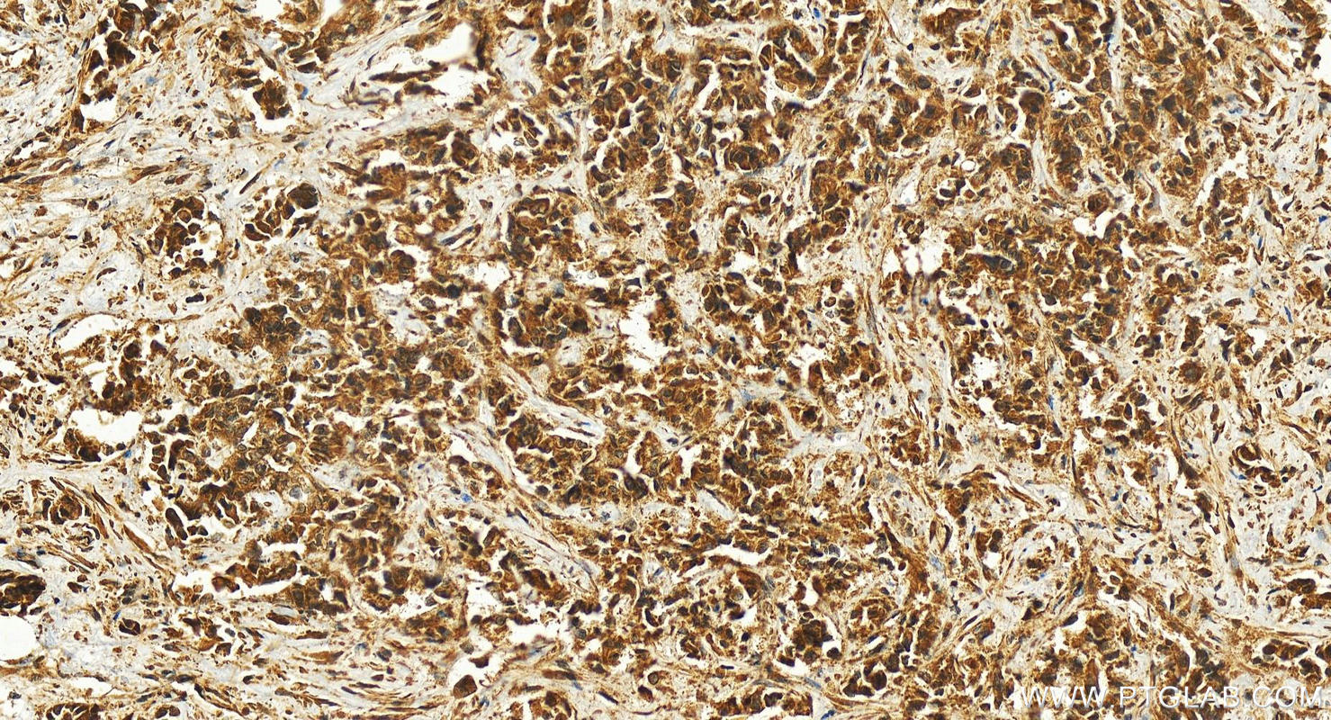 Immunohistochemistry (IHC) staining of human intrahepatic cholangiocarcinoma tissue using KCTD10 Polyclonal antibody (27279-1-AP)