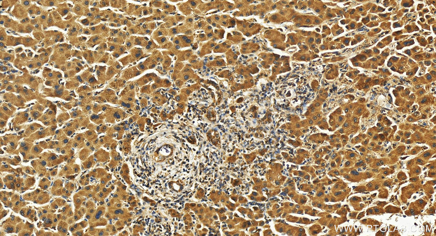 Immunohistochemistry (IHC) staining of human intrahepatic cholangiocarcinoma tissue using KCTD10 Polyclonal antibody (27279-1-AP)