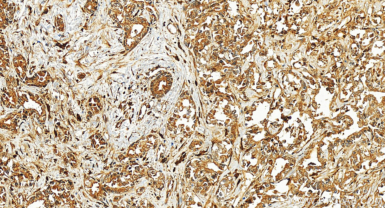 Immunohistochemistry (IHC) staining of human intrahepatic cholangiocarcinoma tissue using KCTD12 Polyclonal antibody (15523-1-AP)