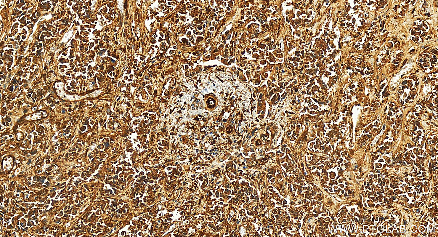 Immunohistochemistry (IHC) staining of human intrahepatic cholangiocarcinoma tissue using KCTD12 Polyclonal antibody (15523-1-AP)