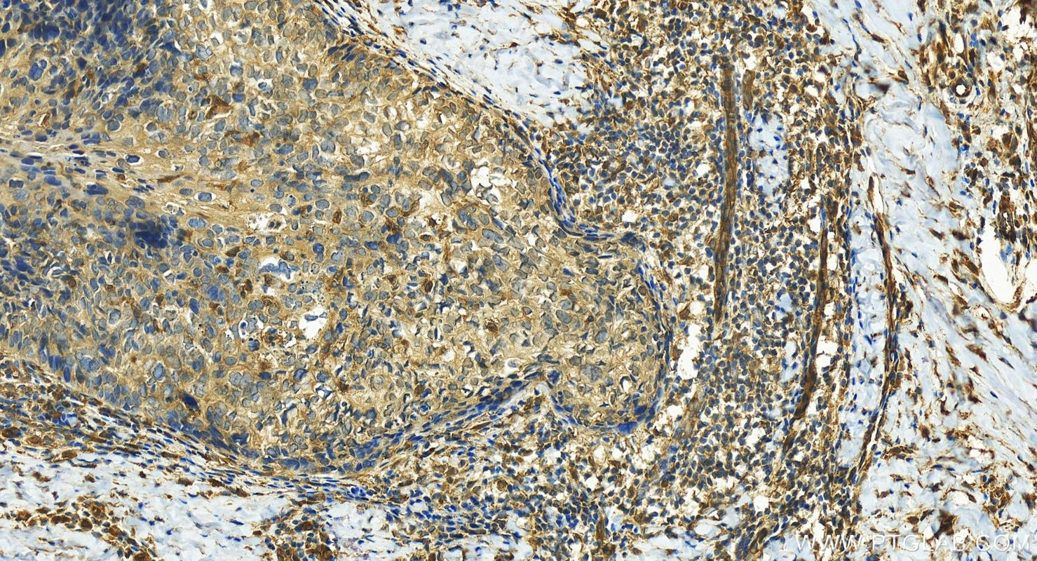 Immunohistochemistry (IHC) staining of human bowen disease using KCTD12 Polyclonal antibody (15523-1-AP)