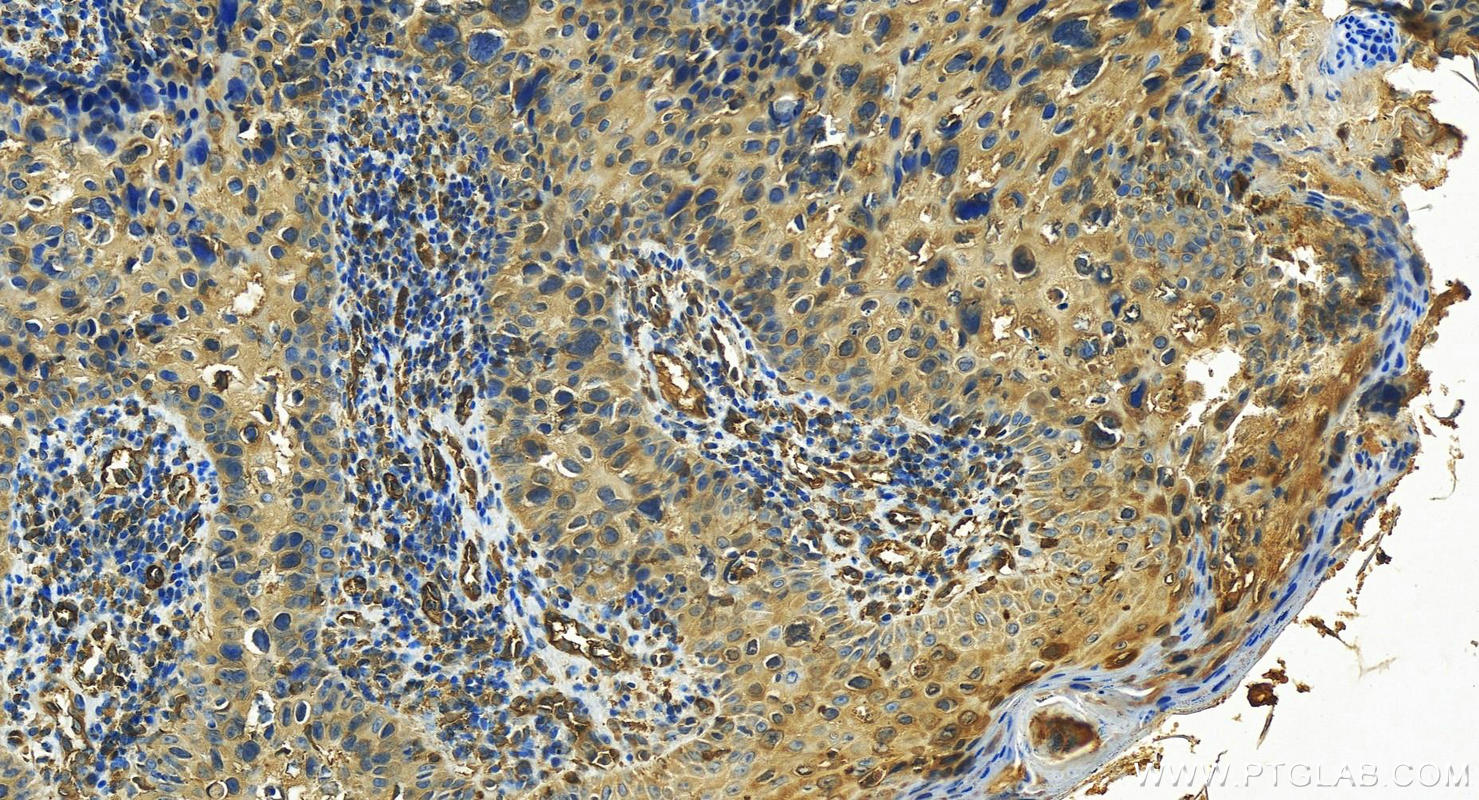 Immunohistochemistry (IHC) staining of human bowen disease using KCTD12 Polyclonal antibody (15523-1-AP)