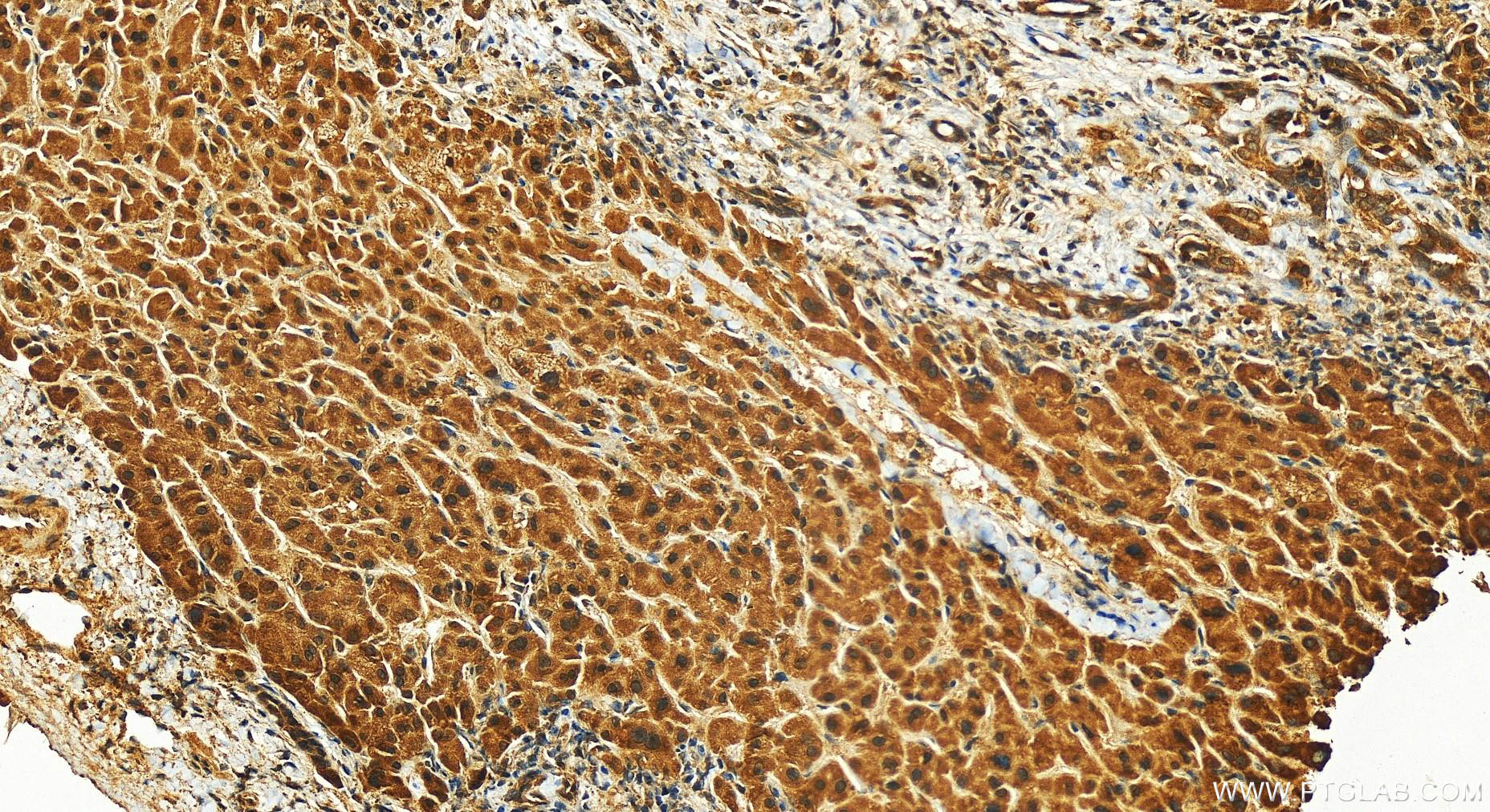 Immunohistochemistry (IHC) staining of human intrahepatic cholangiocarcinoma tissue using KCTD14 Polyclonal antibody (14806-1-AP)