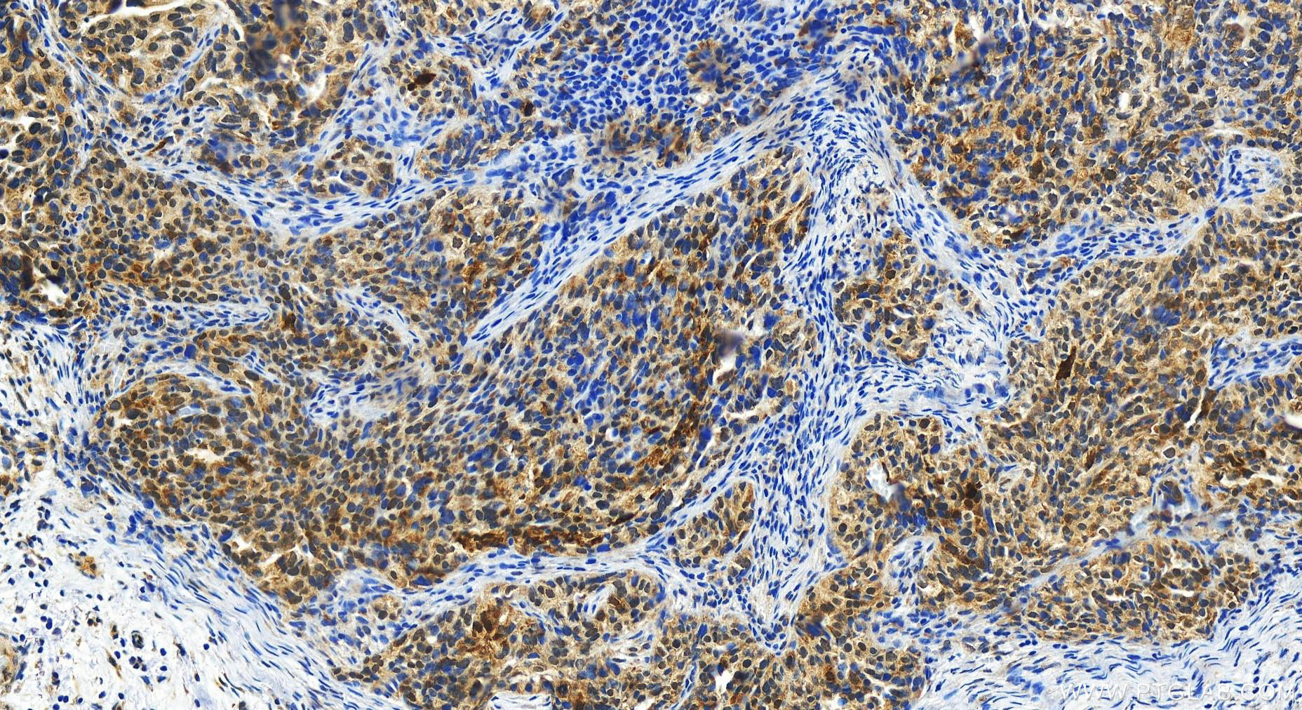 Immunohistochemistry (IHC) staining of human ovary cancer tissue using KCTD14 Polyclonal antibody (14806-1-AP)