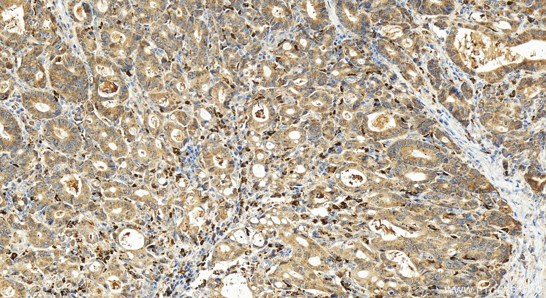 Immunohistochemistry (IHC) staining of human stomach cancer tissue using KCTD14 Polyclonal antibody (21111-1-AP)