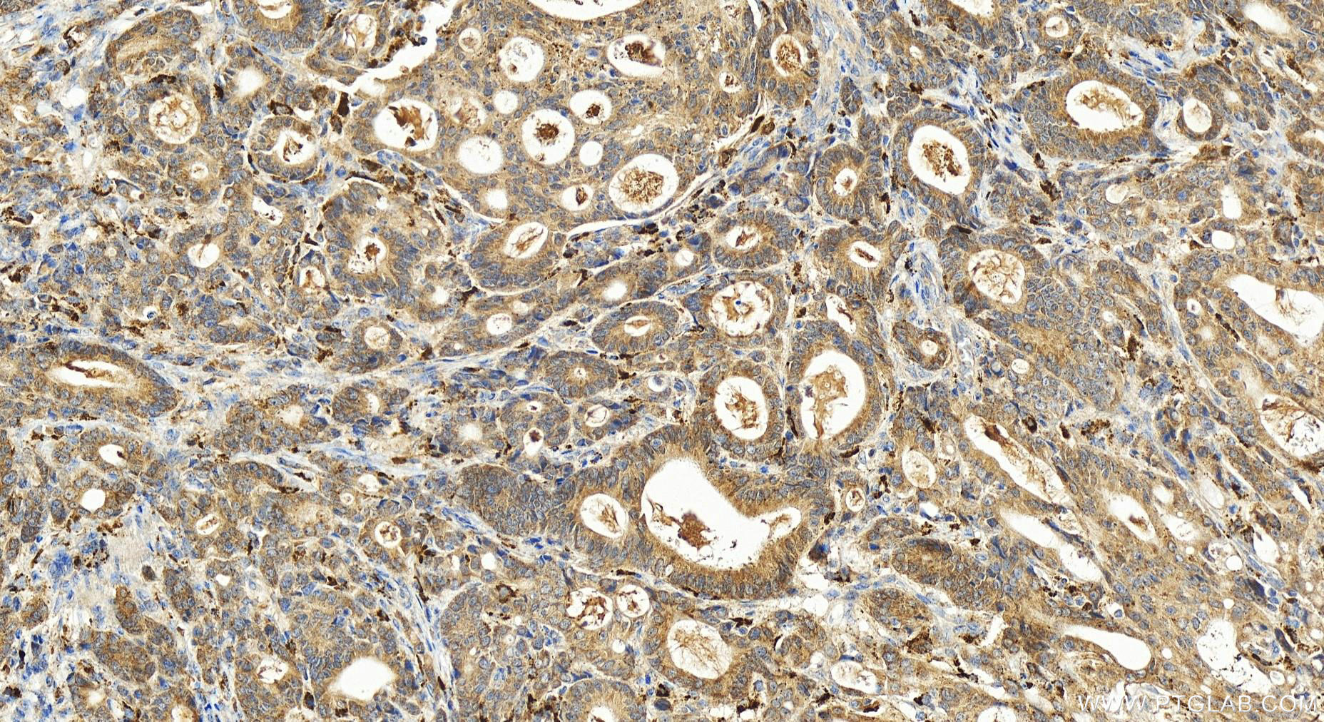 Immunohistochemistry (IHC) staining of human stomach cancer tissue using KCTD14 Polyclonal antibody (21111-1-AP)