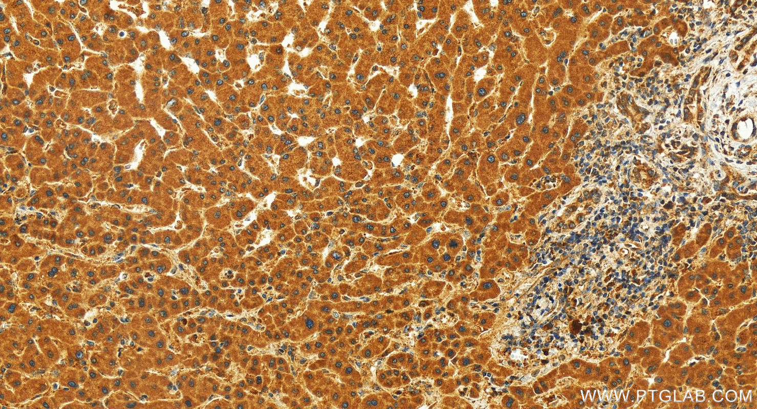 Immunohistochemistry (IHC) staining of human intrahepatic cholangiocarcinoma tissue using KCTD14 Polyclonal antibody (21111-1-AP)