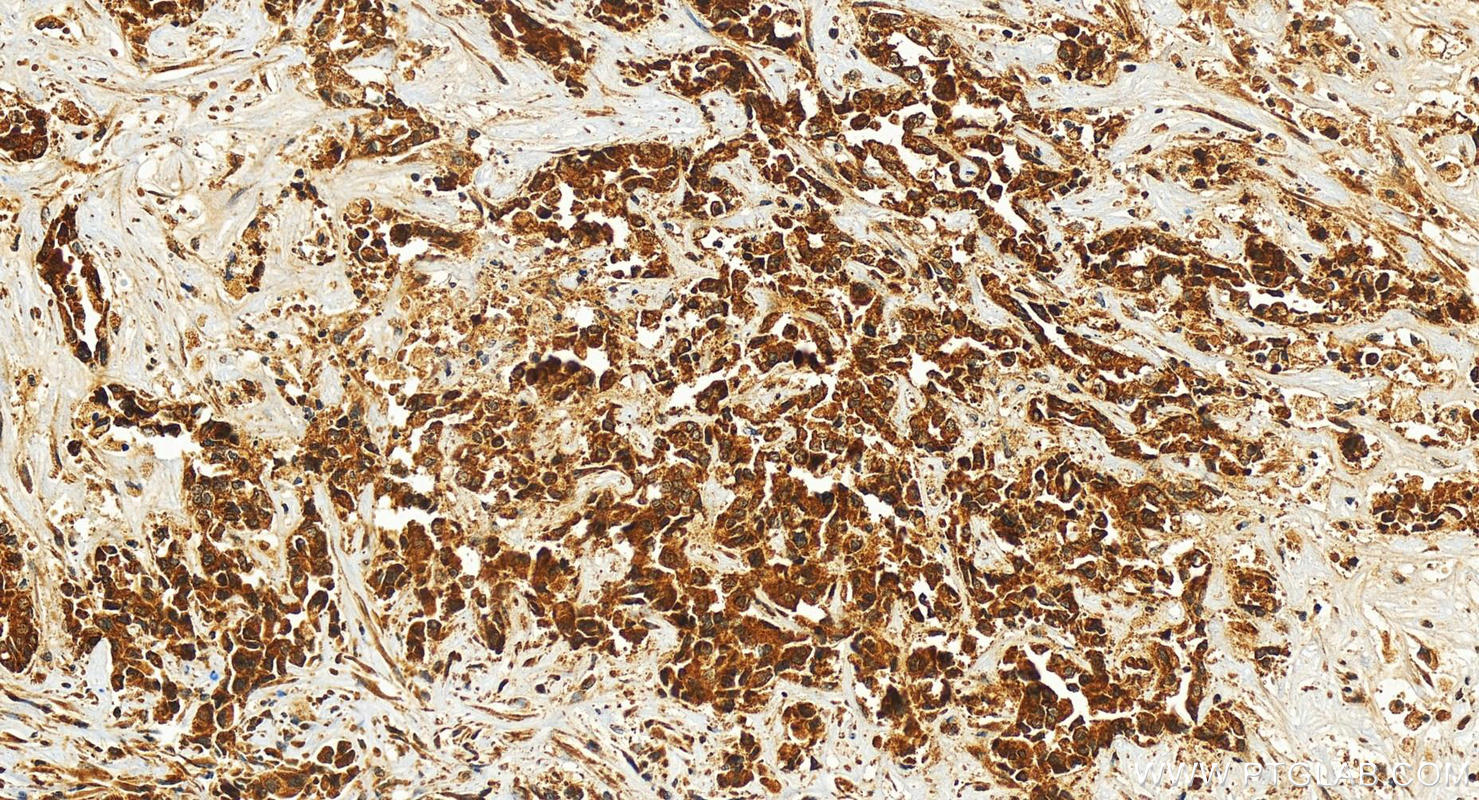 Immunohistochemistry (IHC) staining of human intrahepatic cholangiocarcinoma tissue using KCTD14 Polyclonal antibody (21111-1-AP)