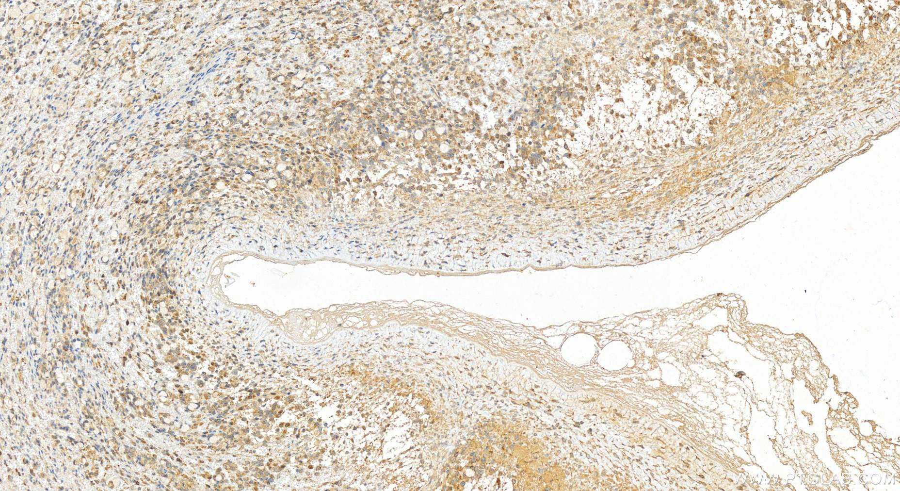 Immunohistochemistry (IHC) staining of human ovary cancer tissue using KCTD14 Polyclonal antibody (21111-1-AP)