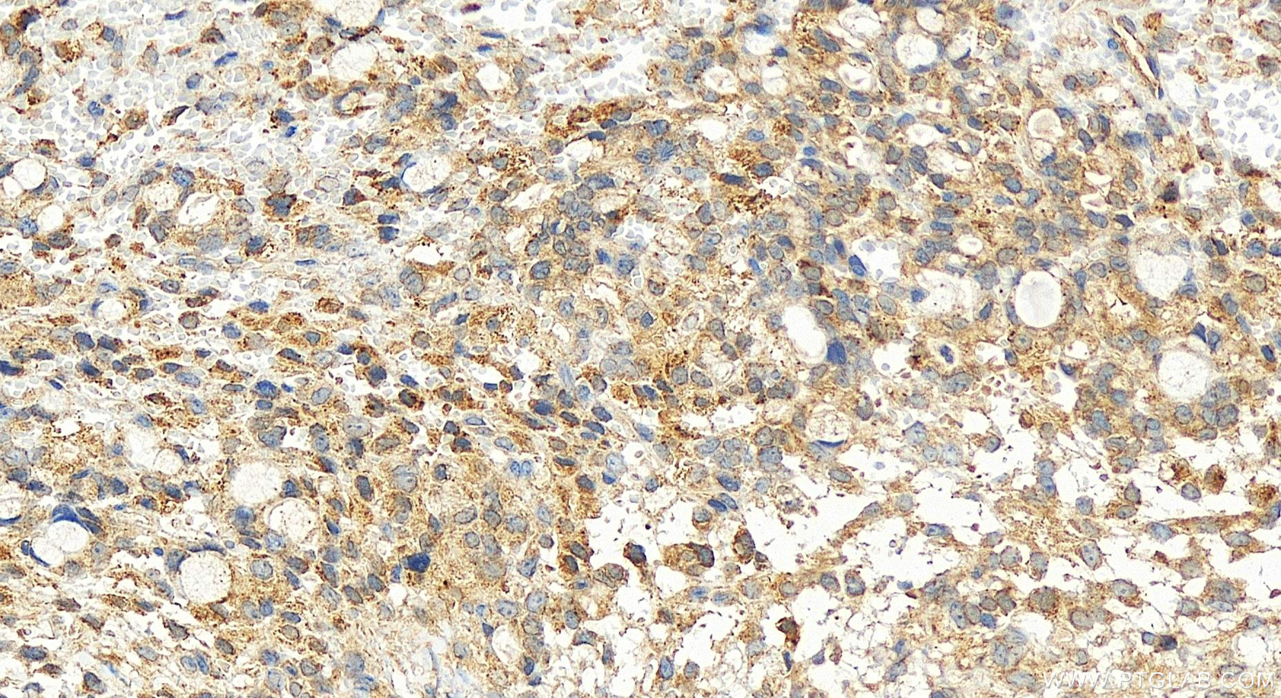 Immunohistochemistry (IHC) staining of human ovary cancer tissue using KCTD14 Polyclonal antibody (21111-1-AP)