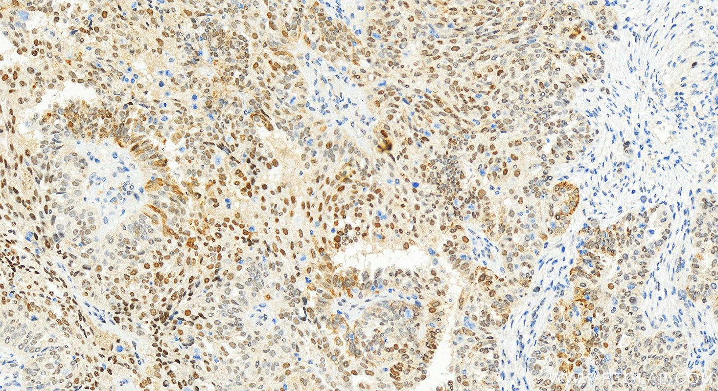 Immunohistochemistry (IHC) staining of human ovarian  cancer using KDM3A/JMJD1A Recombinant antibody (83571-2-RR)