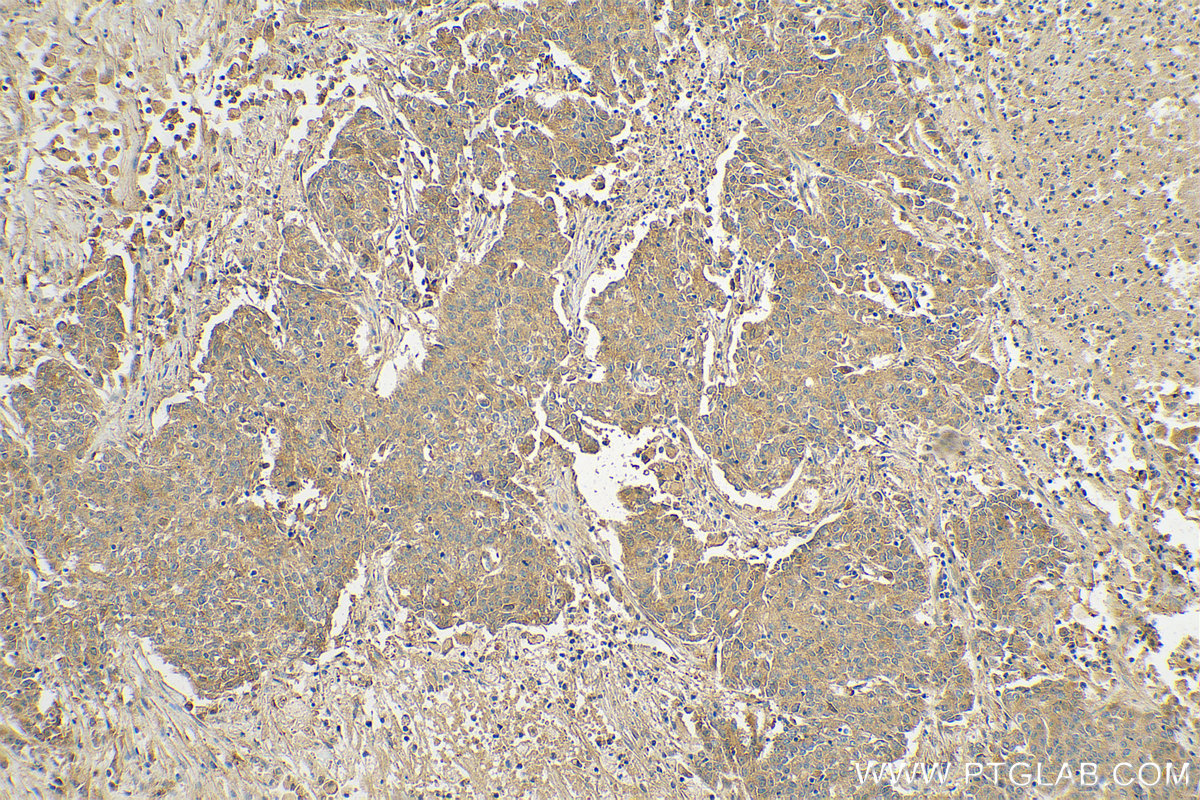 Immunohistochemistry (IHC) staining of human stomach cancer tissue using KHDC1 Polyclonal antibody (23443-1-AP)