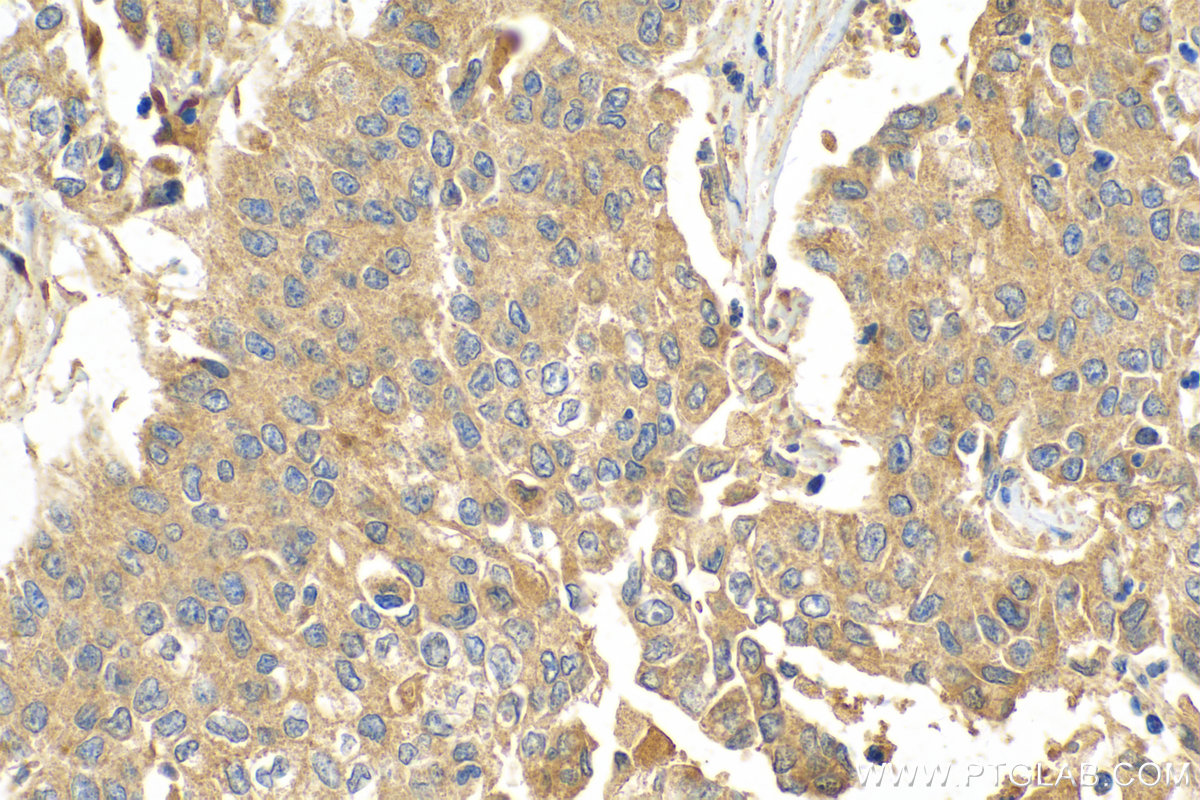 Immunohistochemistry (IHC) staining of human stomach cancer tissue using KHDC1 Polyclonal antibody (23443-1-AP)