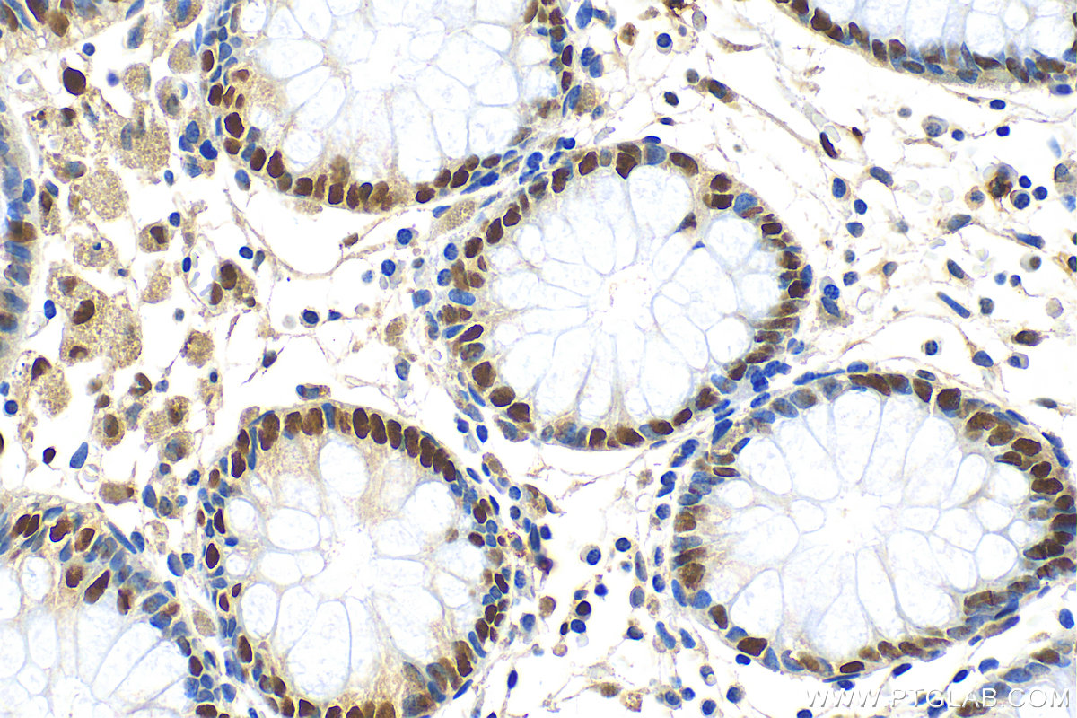 Immunohistochemistry (IHC) staining of human colon tissue using KHSRP Polyclonal antibody (31044-1-AP)