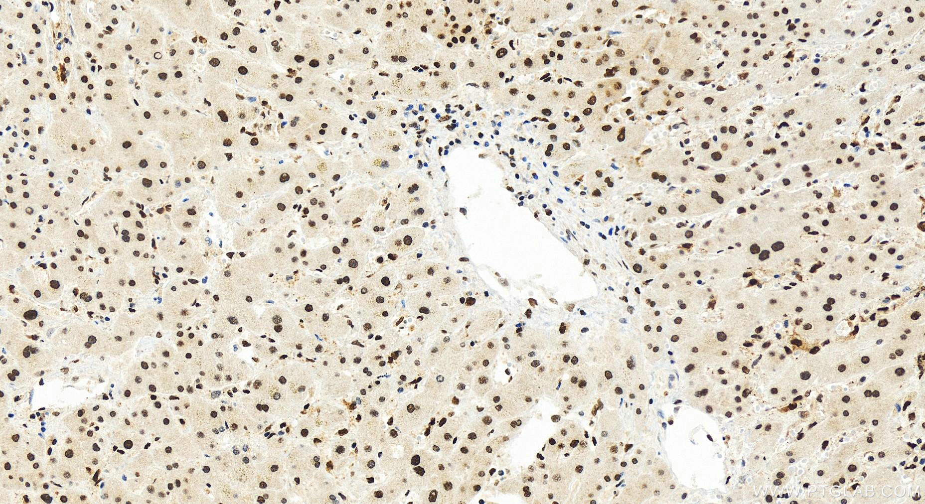 Immunohistochemistry (IHC) staining of human intrahepatic cholangiocarcinoma tissue using KHSRP Recombinant antibody (82931-5-RR)