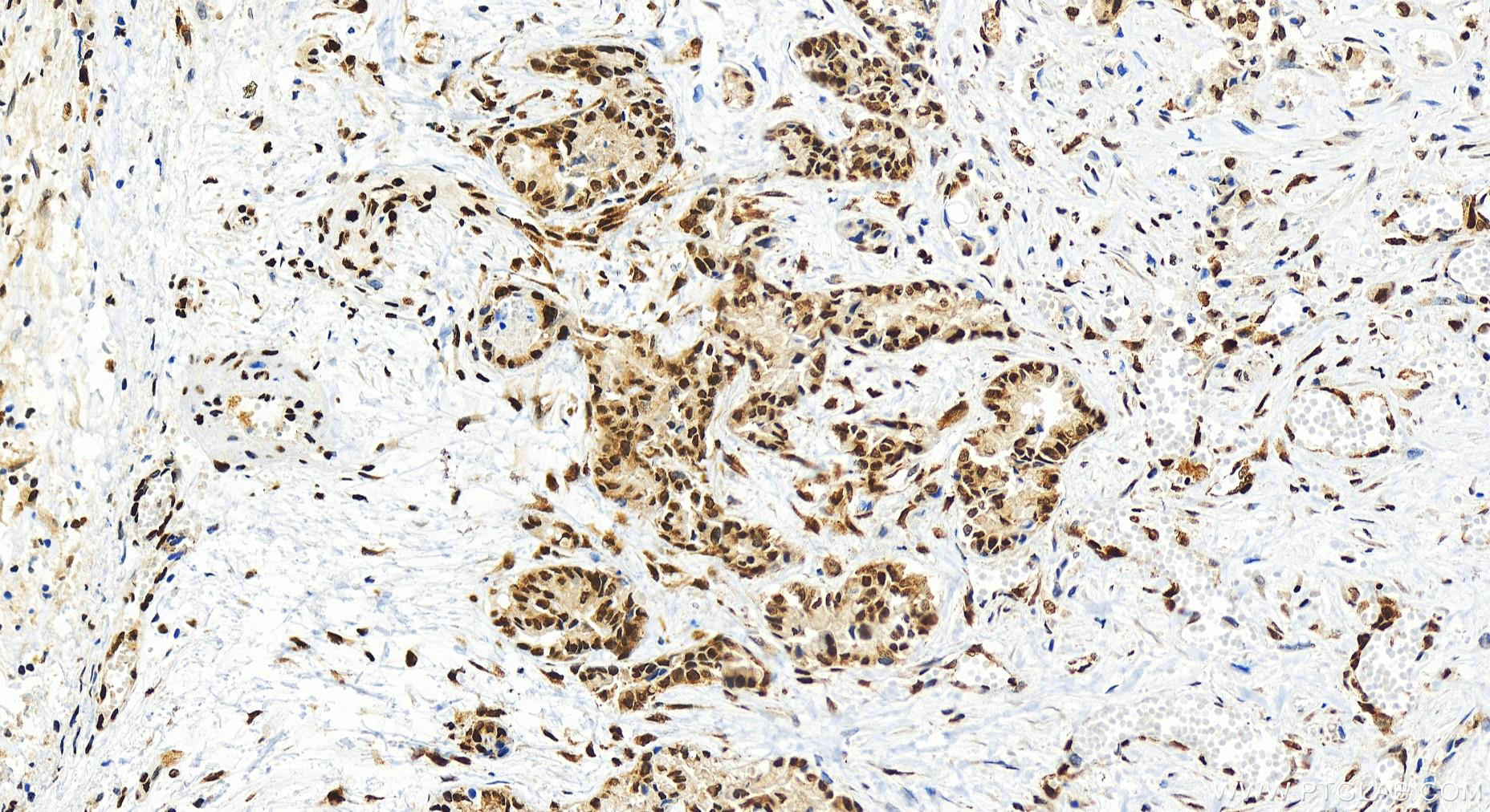 Immunohistochemistry (IHC) staining of human intrahepatic cholangiocarcinoma tissue using KHSRP Recombinant antibody (82931-5-RR)