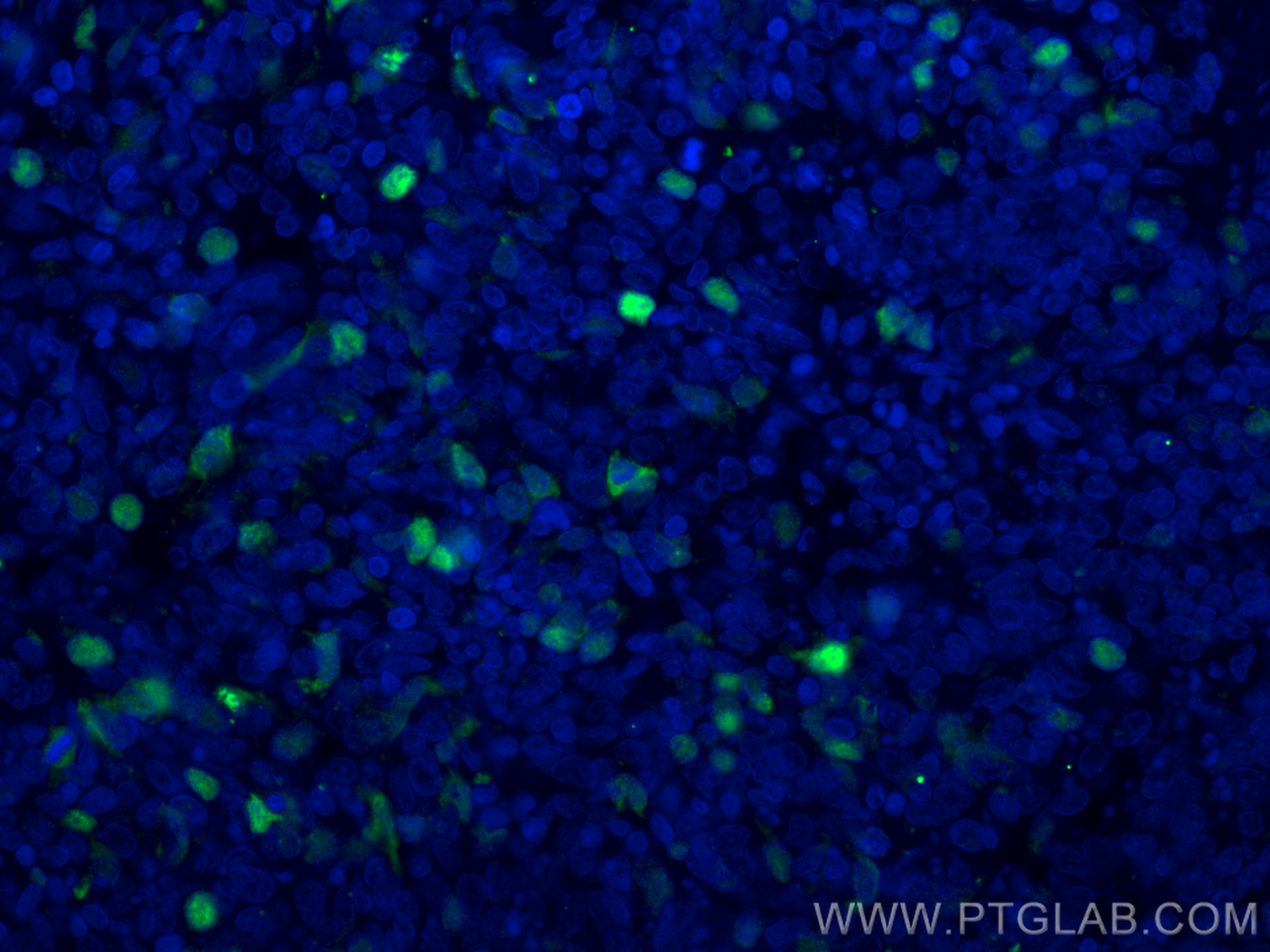 Immunofluorescence (IF) / fluorescent staining of human lung cancer tissue using Ki-67 Polyclonal antibody (27309-1-AP)