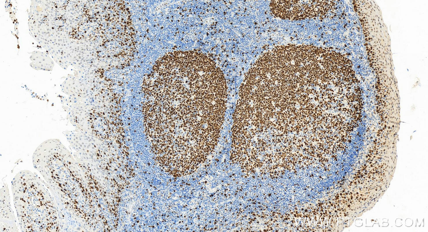 Immunohistochemistry (IHC) staining of human tonsillitis tissue using Ki-67 Polyclonal antibody (27309-1-AP)