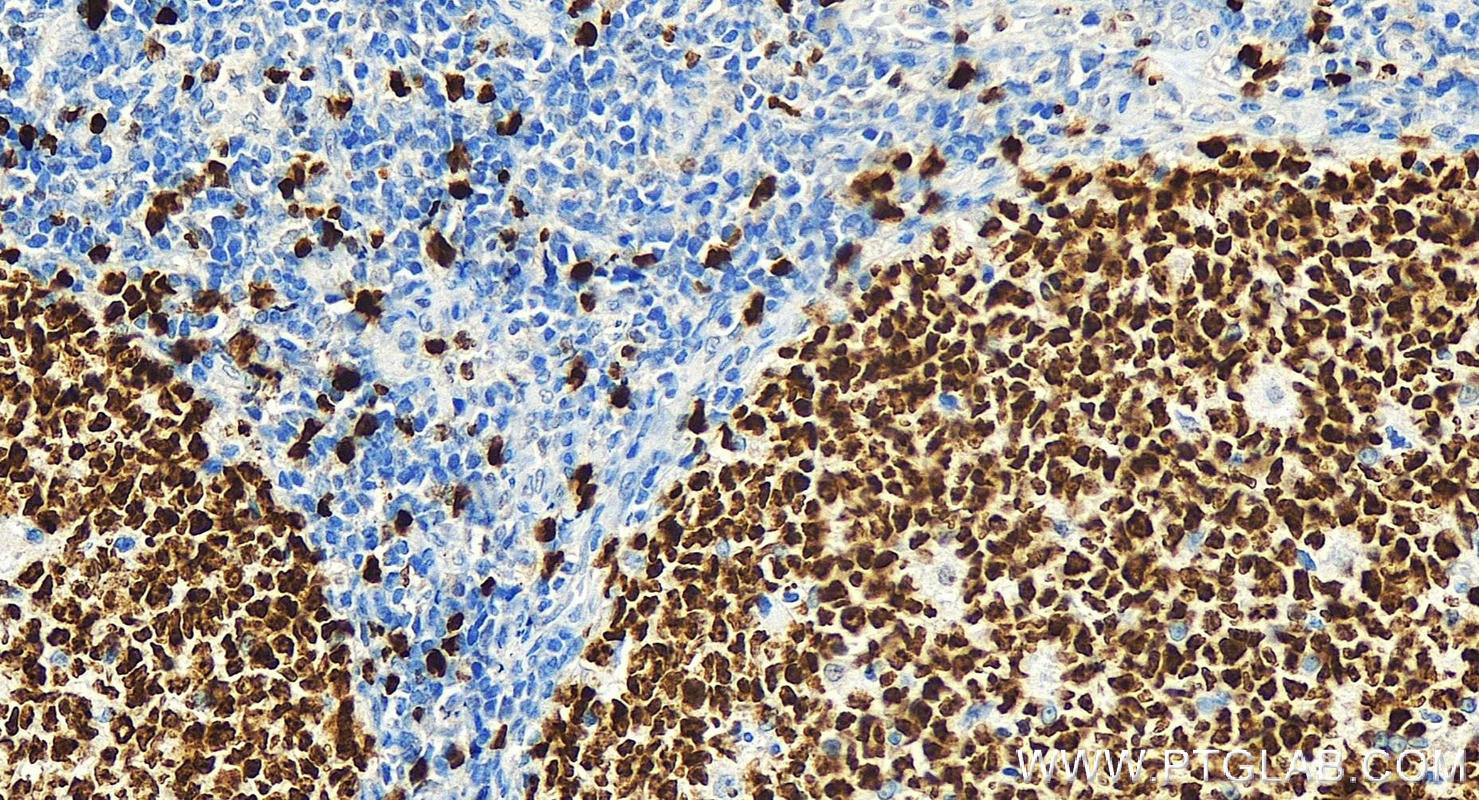 Immunohistochemistry (IHC) staining of human tonsillitis tissue using Ki-67 Polyclonal antibody (27309-1-AP)