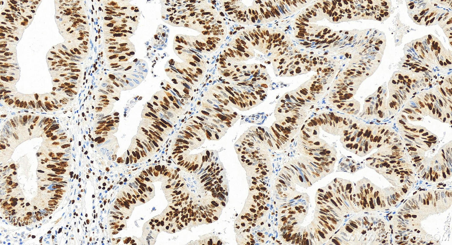 Immunohistochemistry (IHC) staining of human colon cancer tissue using KI67 Recombinant antibody (84192-3-RR)