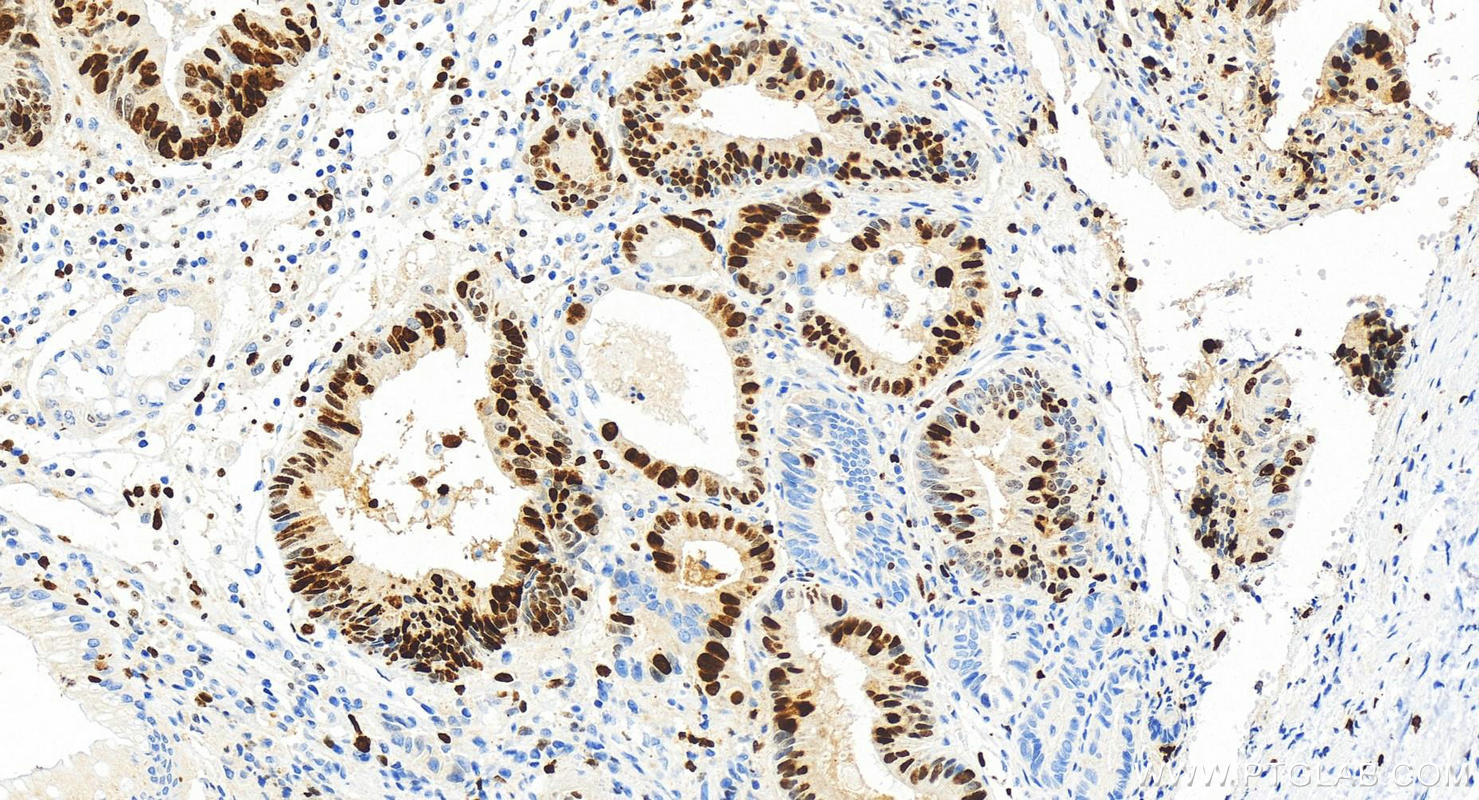 Immunohistochemistry (IHC) staining of human colon cancer tissue using KI67 Recombinant antibody (84192-3-RR)