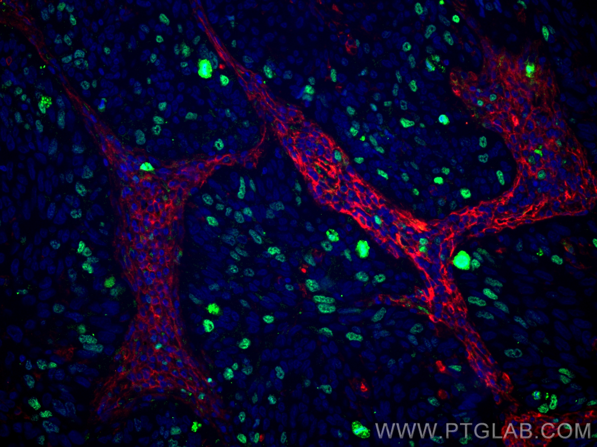 Immunofluorescence (IF) / fluorescent staining of human lung cancer tissue using KI67 Recombinant antibody (84192-3-RR)