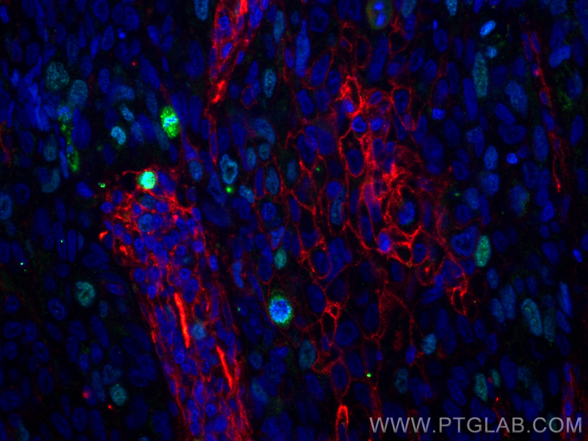 Immunofluorescence (IF) / fluorescent staining of human lung cancer tissue using KI67 Recombinant antibody (84192-3-RR)