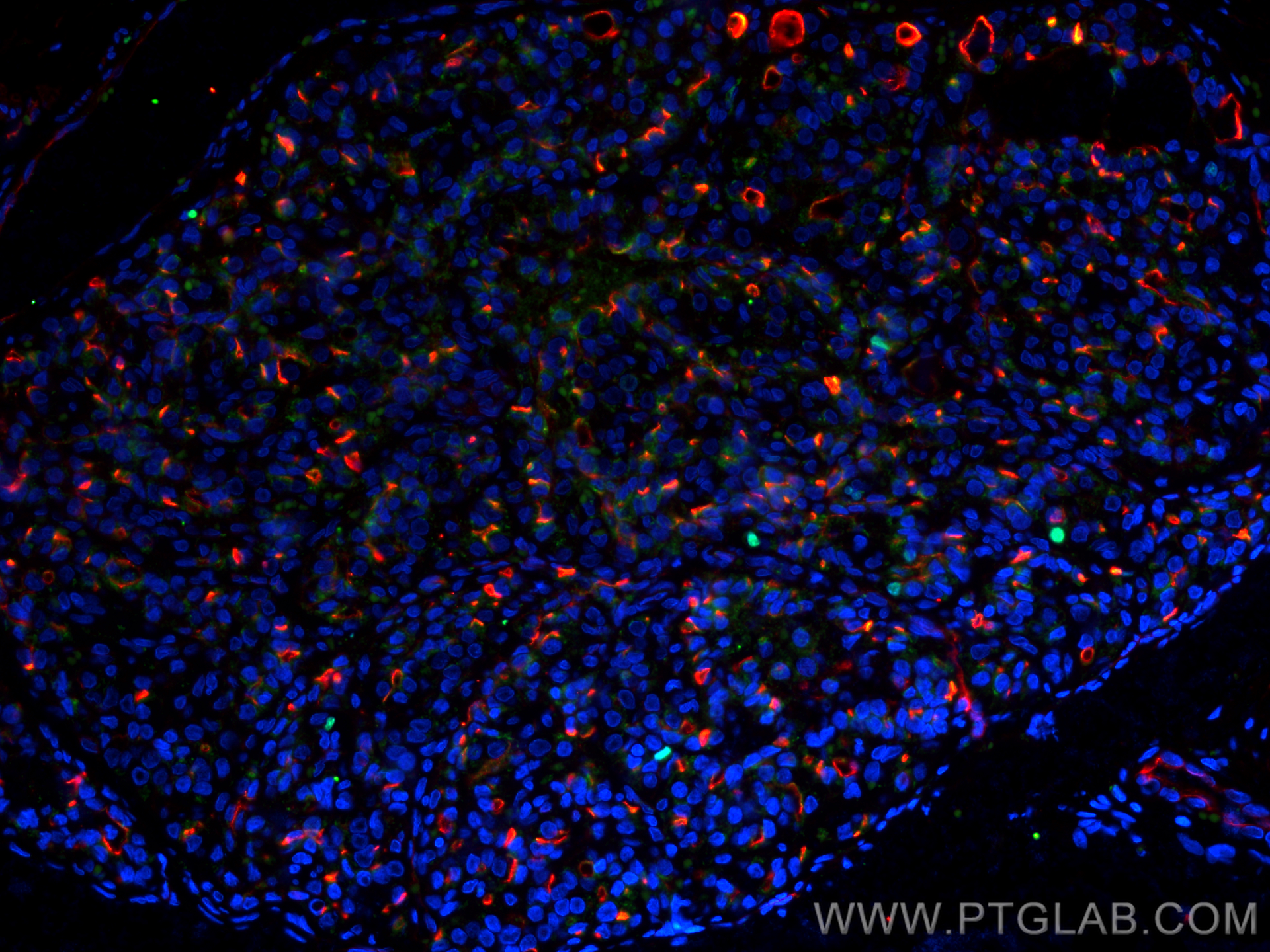 Immunofluorescence (IF) / fluorescent staining of human thyroid cancer tissue using KI67 Recombinant antibody (84192-3-RR)