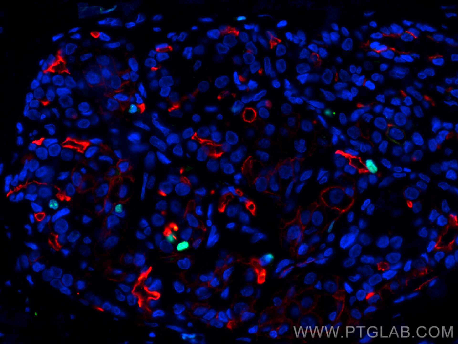 Immunofluorescence (IF) / fluorescent staining of human thyroid cancer tissue using KI67 Recombinant antibody (84192-3-RR)