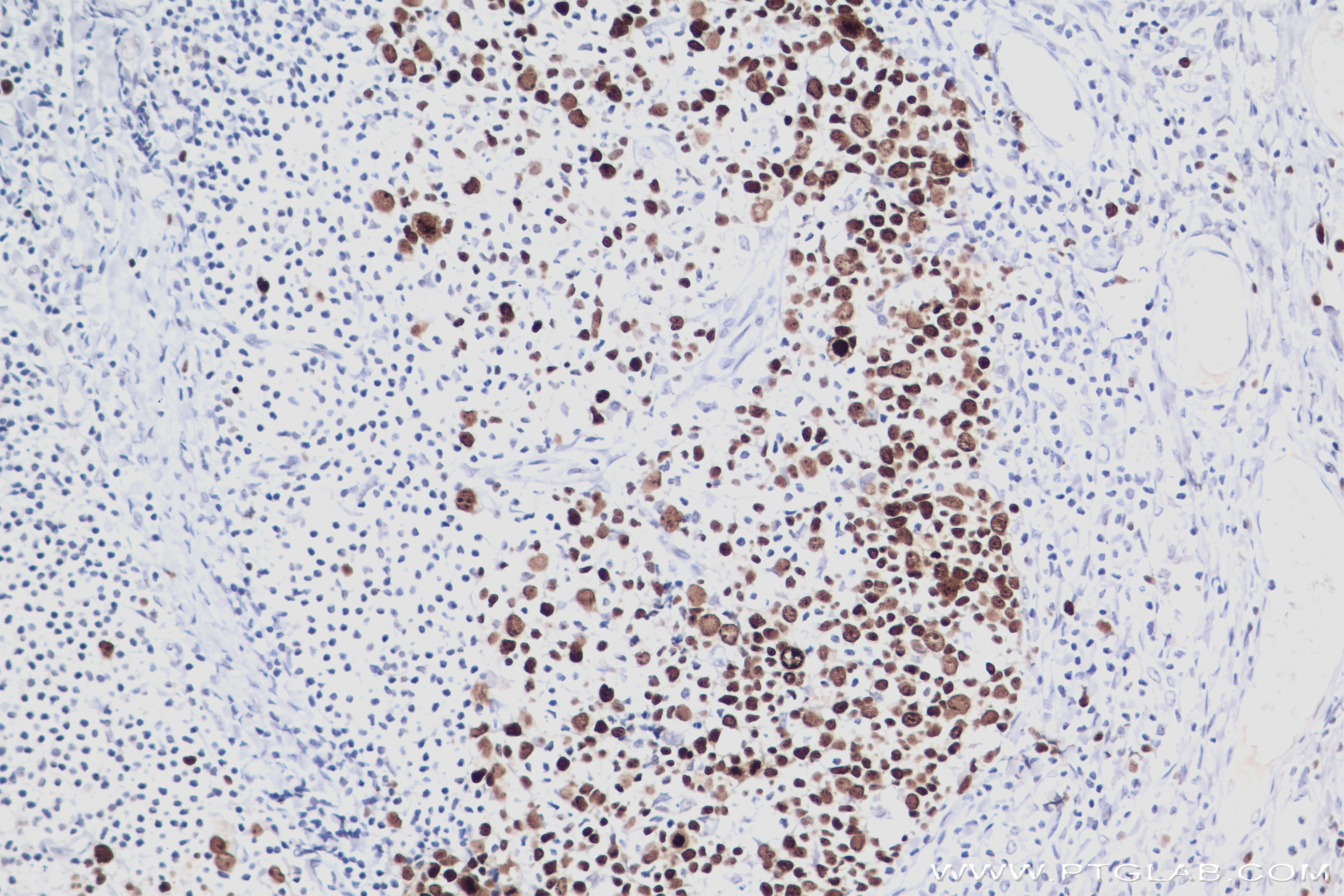 Immunohistochemistry (IHC) staining of human malignant melanoma tissue using KI67 Recombinant antibody (84192-3-RR)