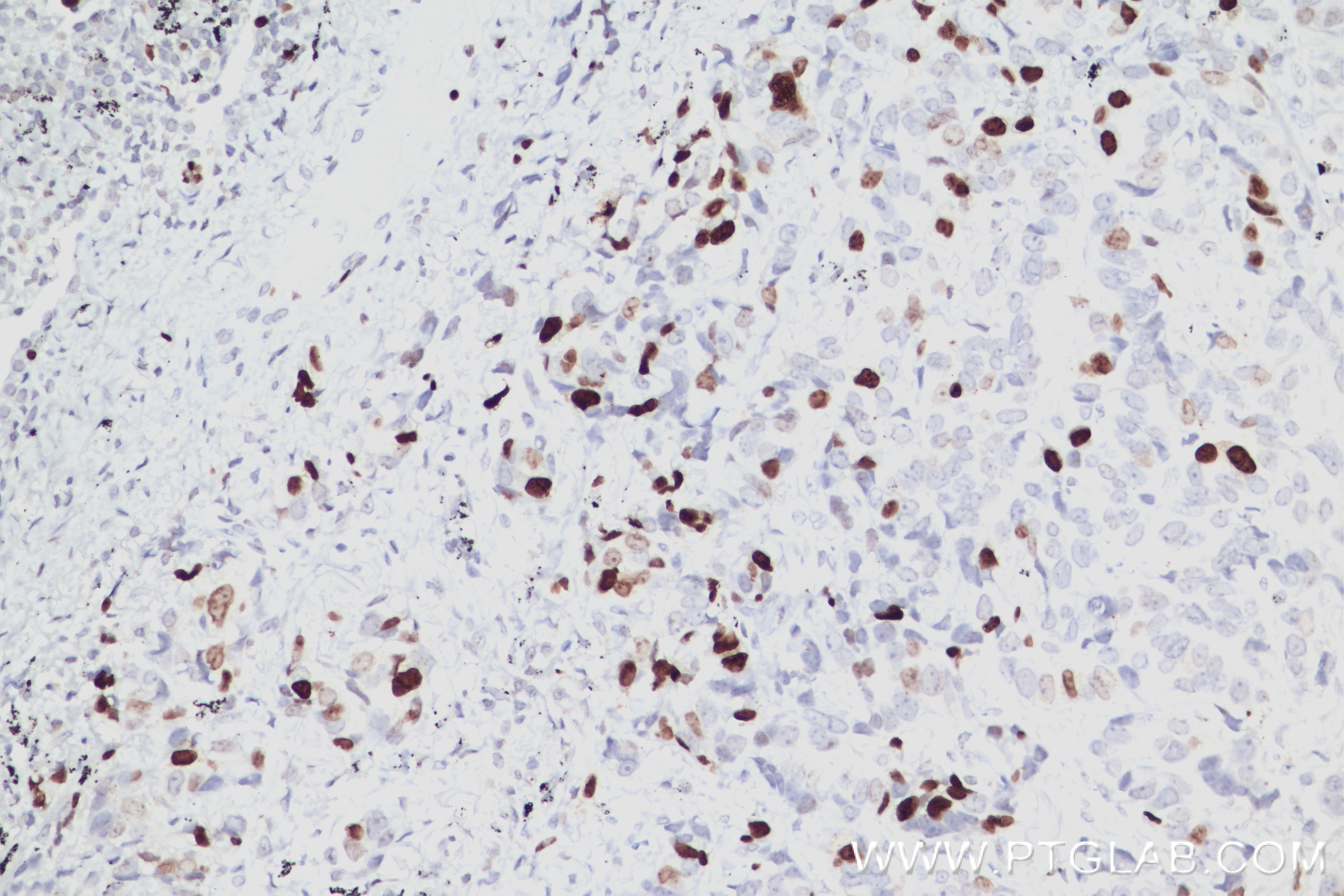 Immunohistochemistry (IHC) staining of human lung cancer tissue using KI67 Recombinant antibody (84192-3-RR)