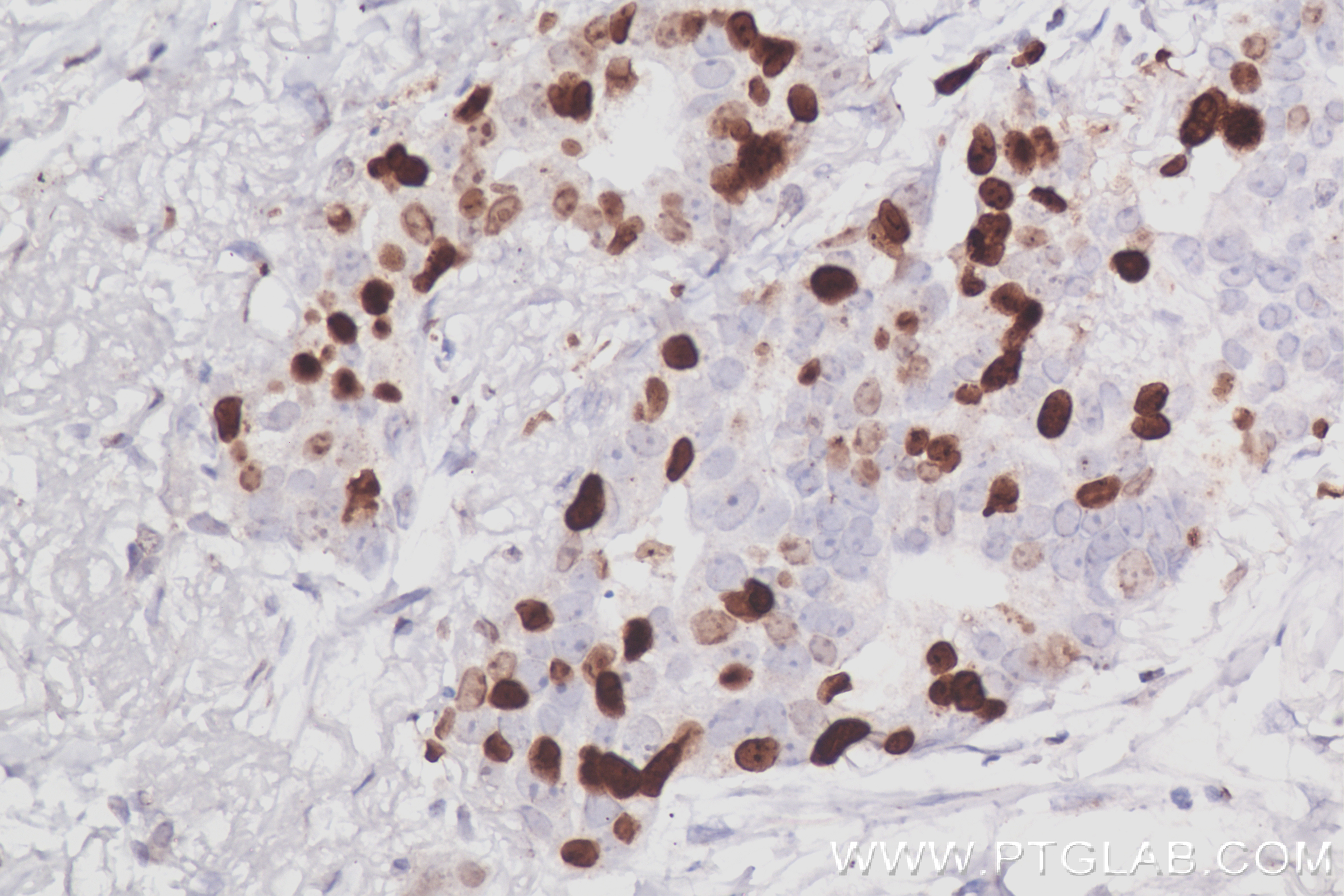 Immunohistochemistry (IHC) staining of human lung cancer tissue using KI67 Recombinant antibody (84192-3-RR)