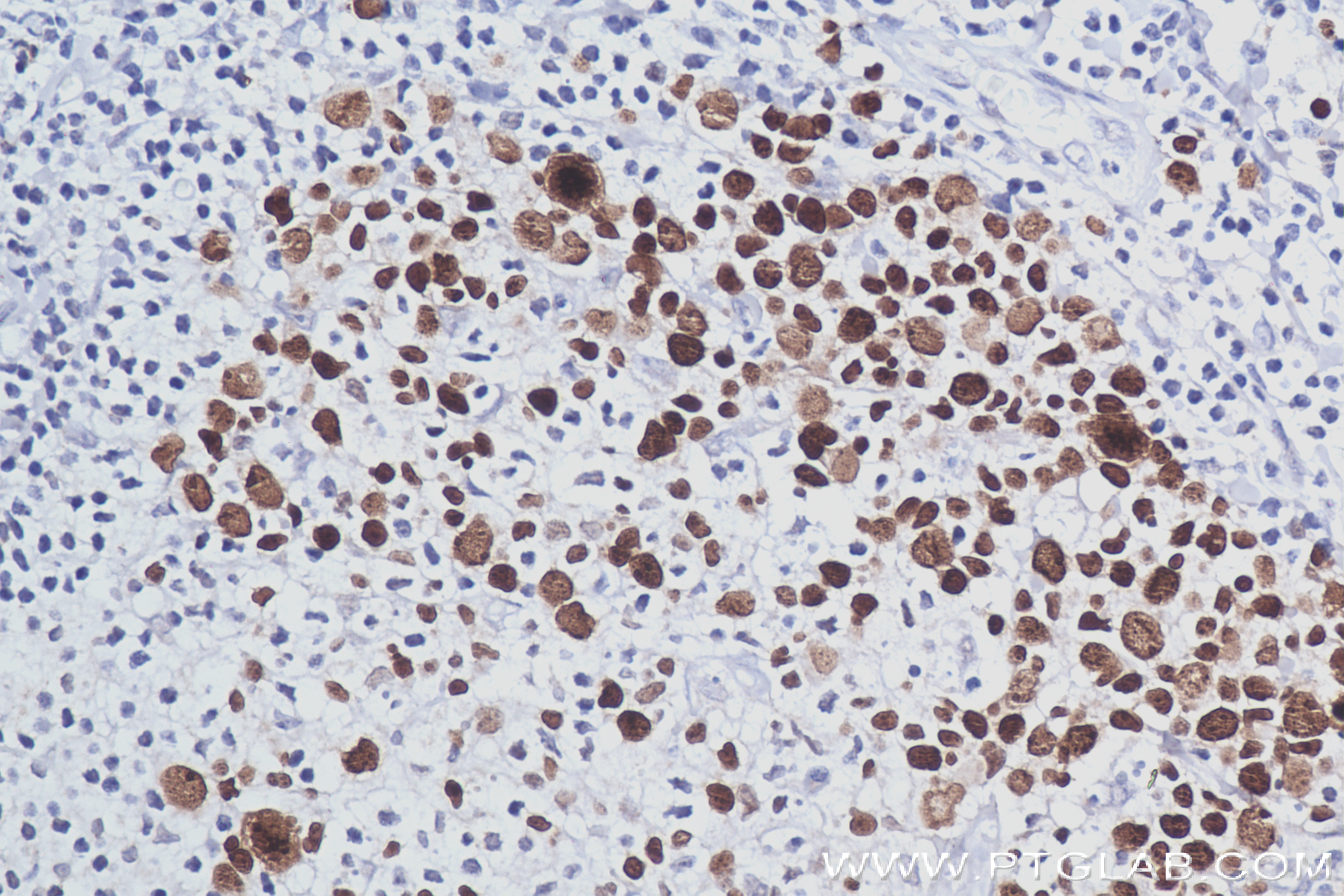 Immunohistochemistry (IHC) staining of human malignant melanoma tissue using KI67 Recombinant antibody (84192-3-RR)